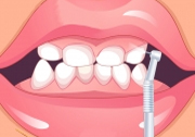 Diş Temizleme